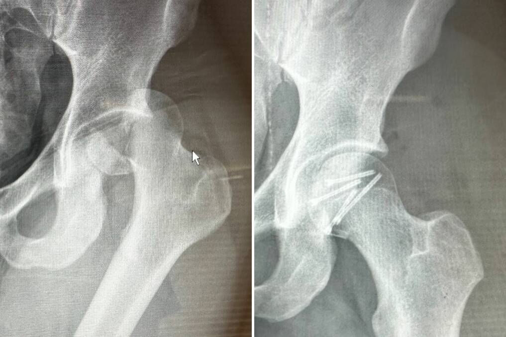 Kyle Hardy's hip was wrenched from its socket (left) and required multiple surgeries and five screws (right) to correct. Picture supplied