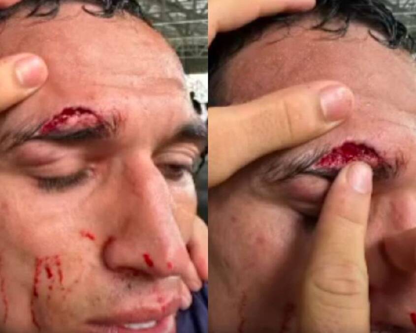 The eye injury that's ruled Charles Oliveira out of UFC 294. 