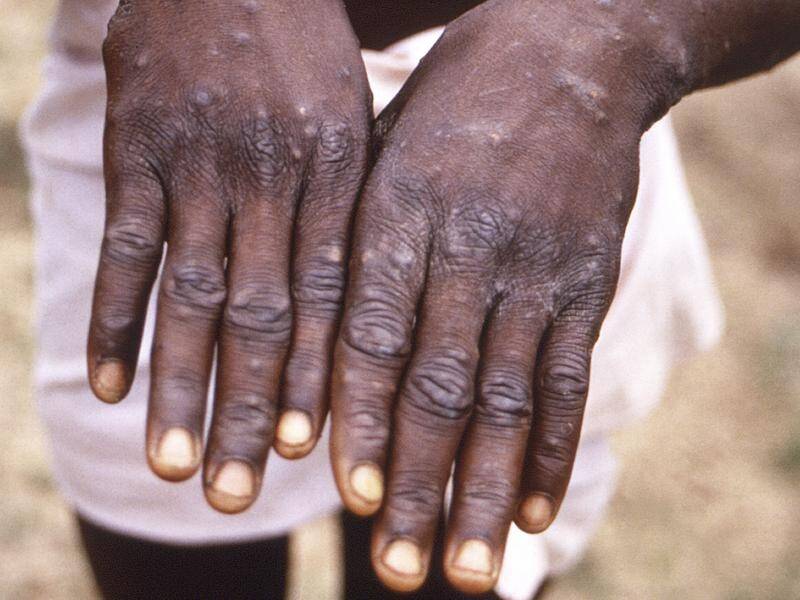 A Sydney man who recently returned from Queensland has been diagnosed with monkeypox.